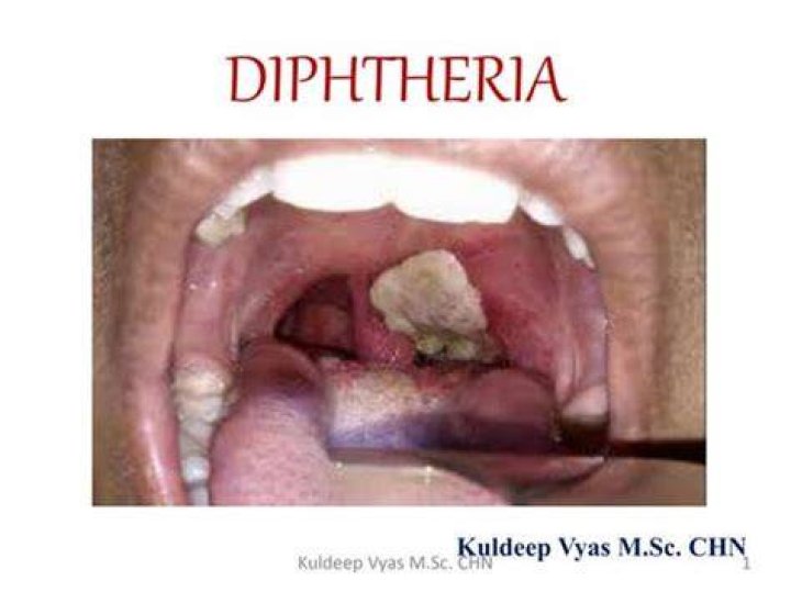 A case of diphtheria was confirmed at a school in Luton