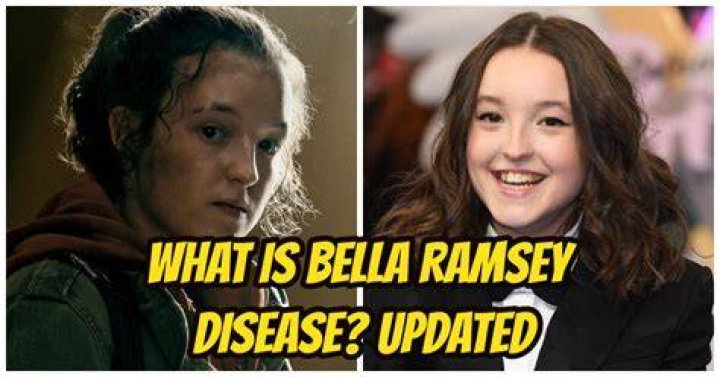 Bella Ramsey Disease: What Disease Does She Have?