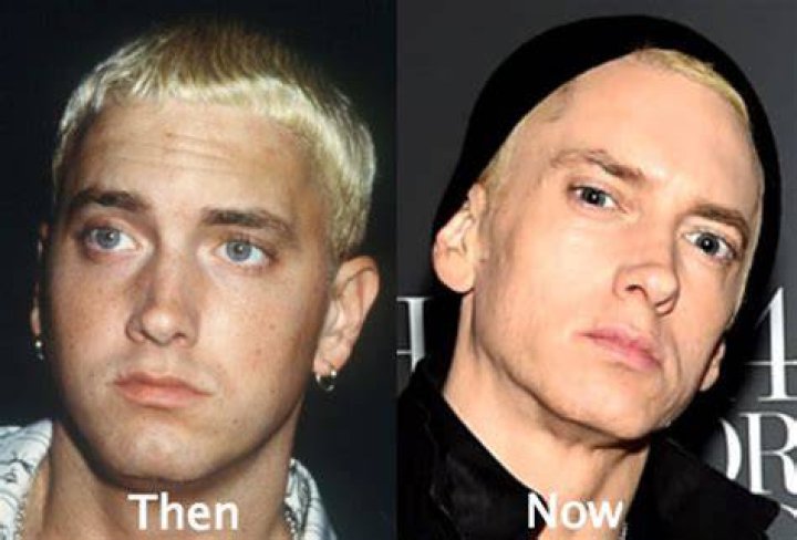Eminem plastic surgery 02 Celebrity plastic surgery online