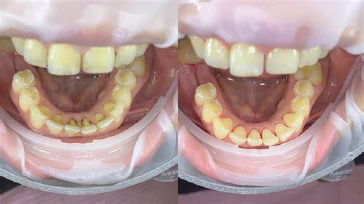 Ken cleaning his teeth after insuring them for £10,000