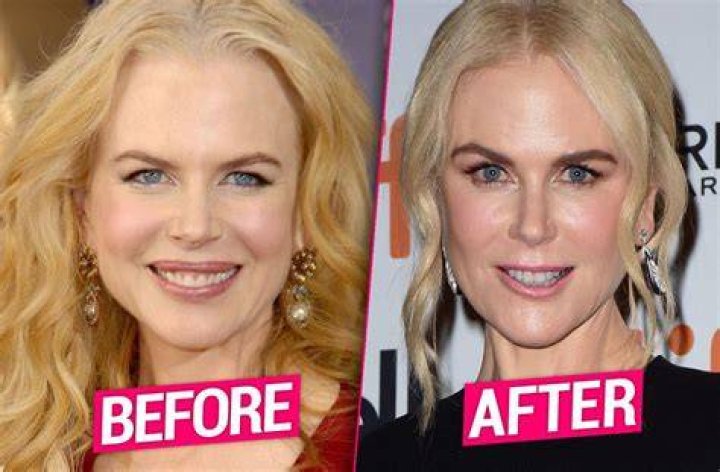 Nicole Kidman Botox Was An Unfortunate Move But Now I Can Move My Face